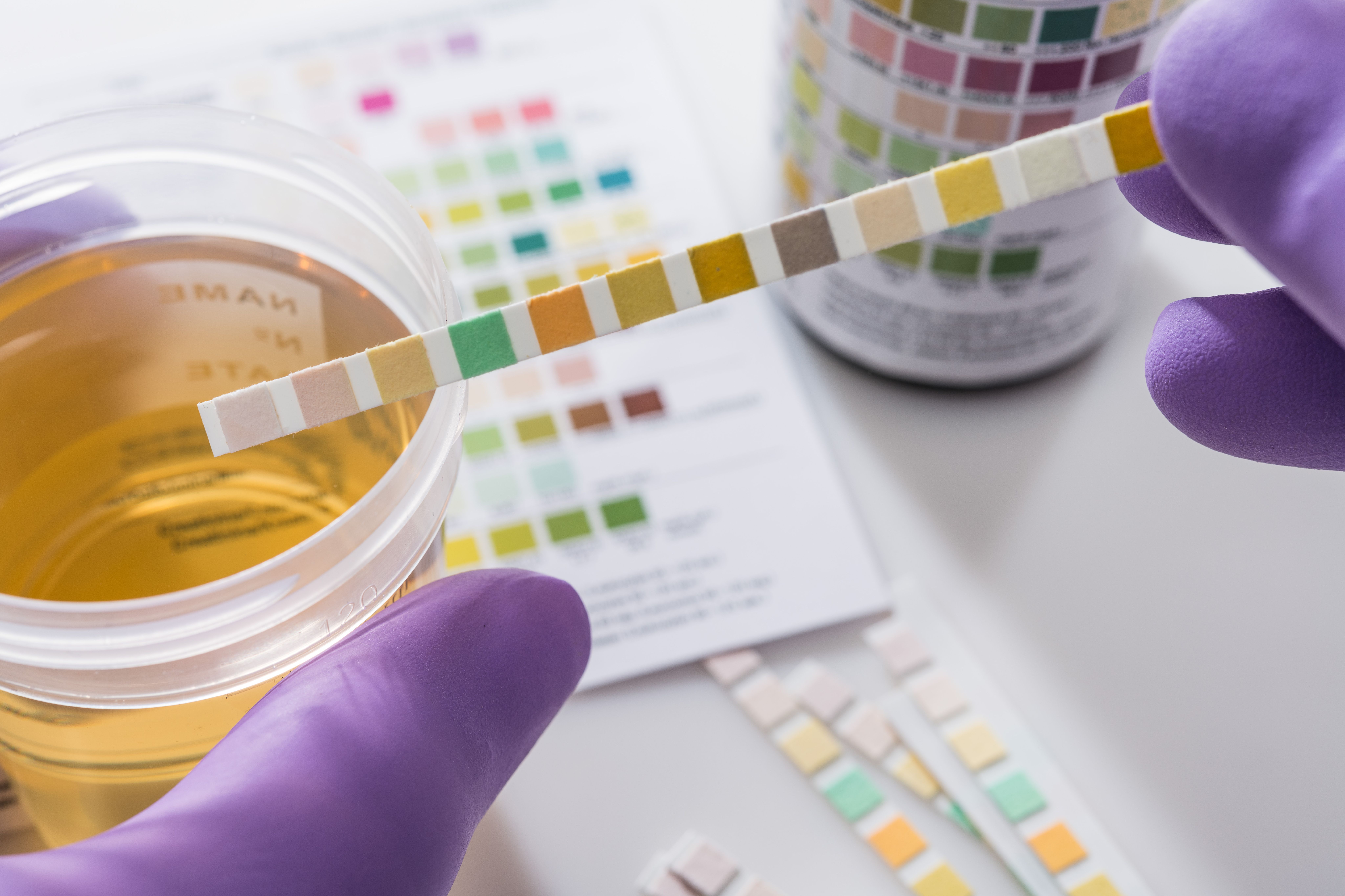 urine test strips in purple gloves | Image Credit: © Lothar Drechsel - stock.adobe.com
