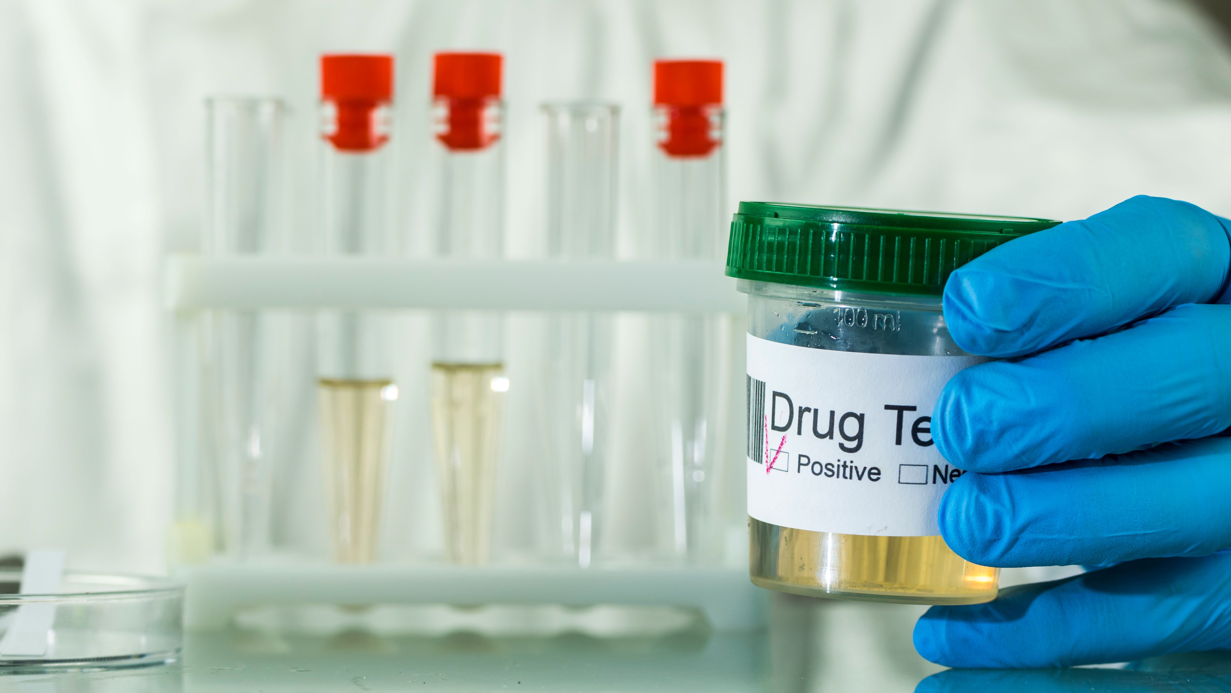 Hand in glove holds a jar with urine analysis where mark a positive test for doping or drug | Image Credit: © StockMediaProduction - stock.adobe.com