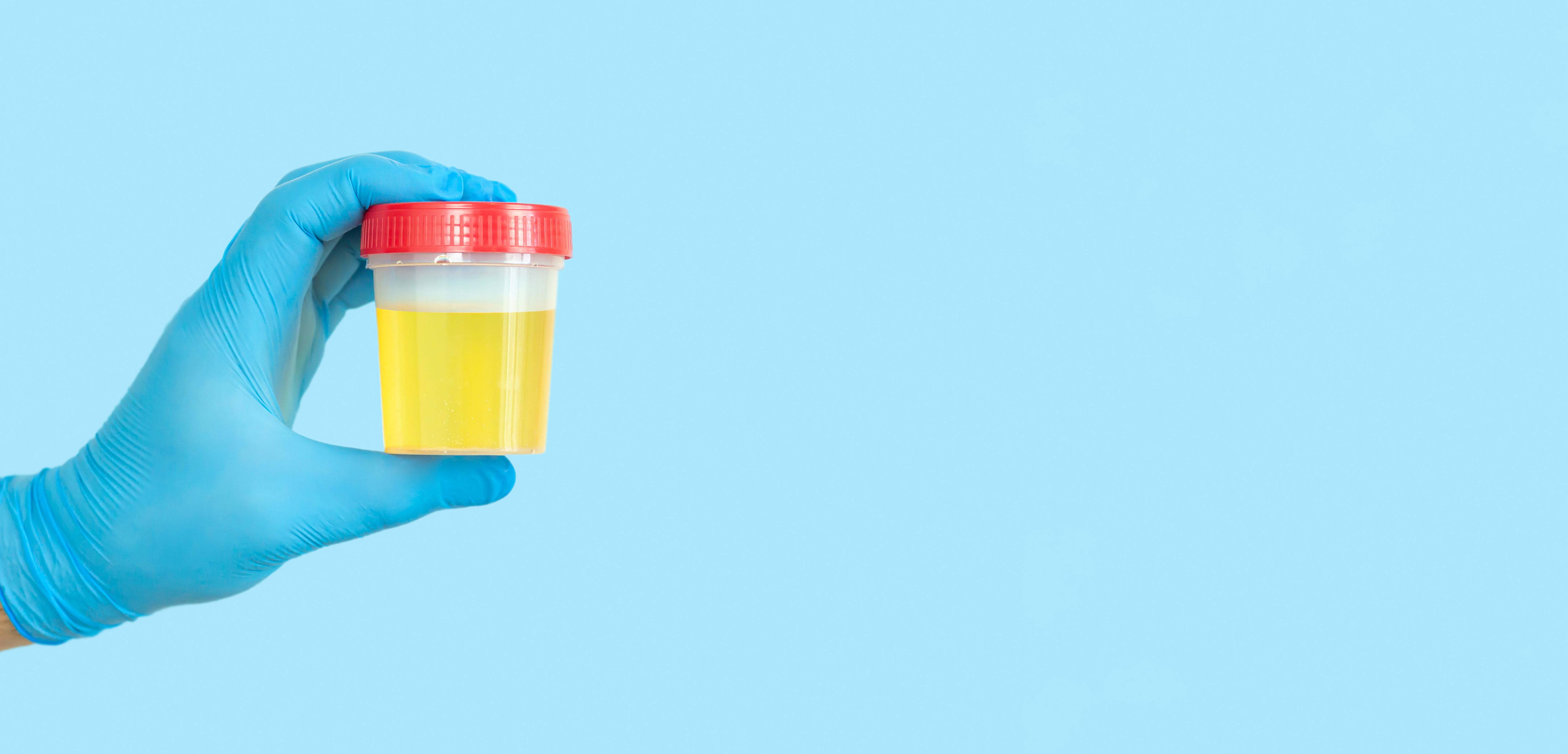Hand holding urine sample container for medical urinalysis | Image Credit: © Дмитрий Сидор - stock.adobe.com