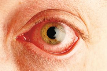 conjunctivitis.jpg