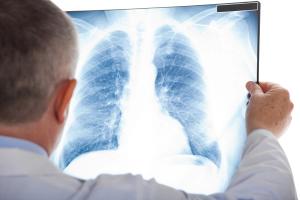 LC-MS Assists in Blood Test Targeting Lung Cancer Detection
