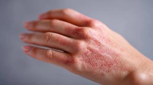 Chromatography Purification Isolates Fish Peptide for Eczema Relief