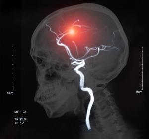 UHPLC-HRMS Lipidomics and Post-Stroke Cognition