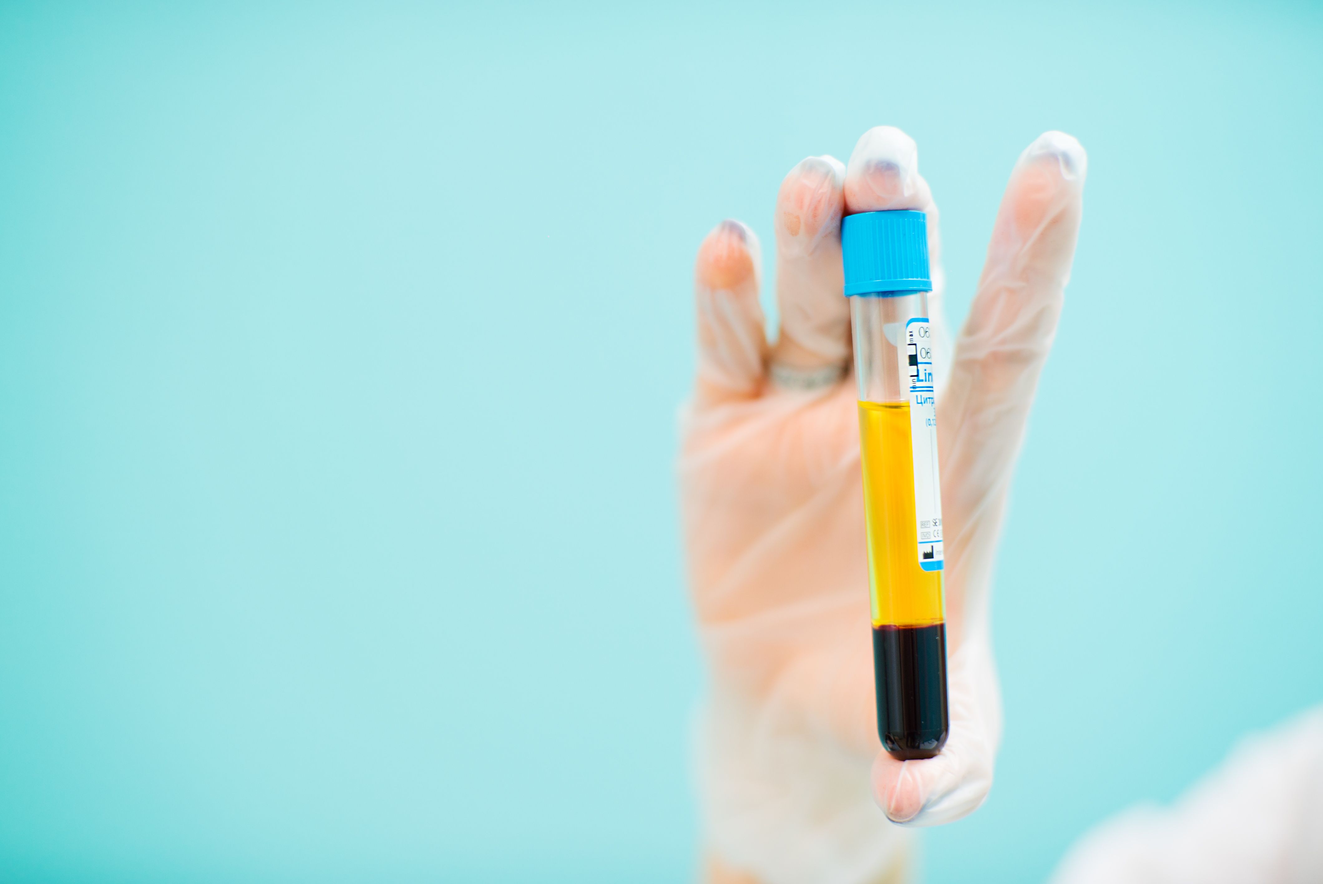 Medical cosmetology blood plasma | Image Credit: © zorgens - stock.adobe.com