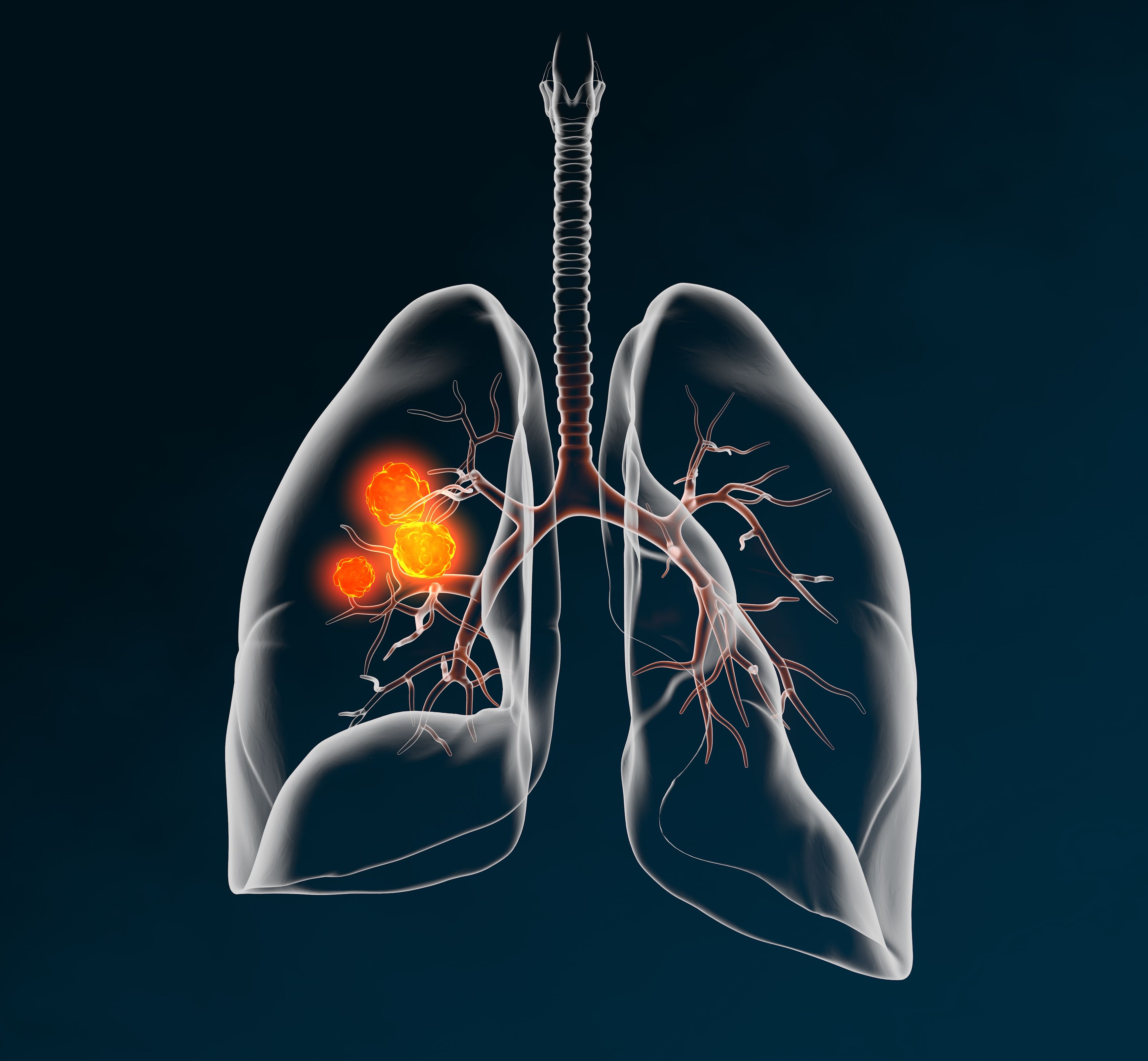 Lung cancer, medically 3D illustration on dark background | Image Credit: © Axel Kock - stock.adobe.com