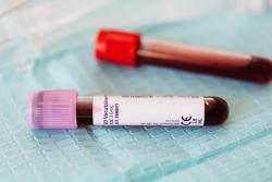 HIV Testing and Diagnoses Drop During COVID-19 Pandemic 