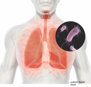 Hospital-Acquired and Ventilator-Associated Pneumonia: Highlights and Pitfalls of the 2016 IDSA / ATS Guidelines