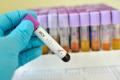 Type I Interferon Response Linked to Resistance to HCV Infection