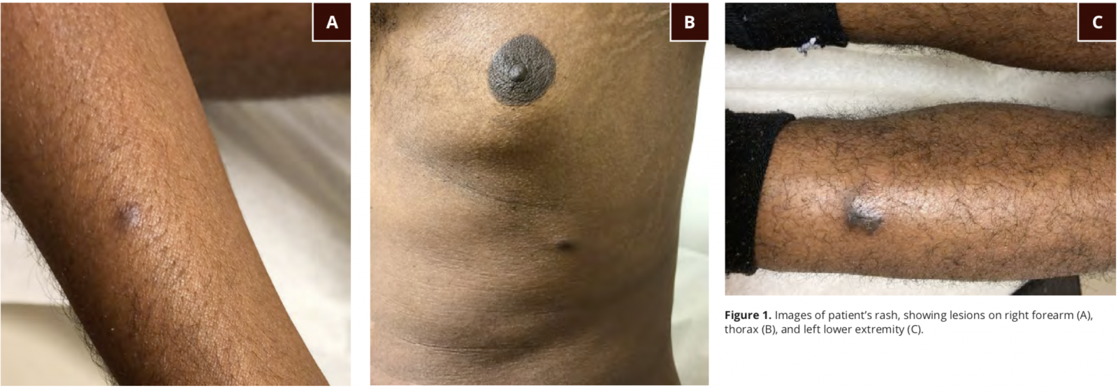Never Ignore A New Rash In A Patient With Aids Never Ignore A New Rash In A Patient With Aids