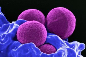 Simplifying the Complex: Dalbavancin as an Option for Treatment of Staphylococcus aureus Bacteremia
