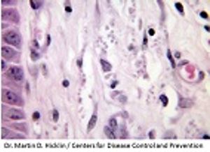Unique Parasite Strain Causes Atypical Leishmaniasis Cases in Brazil