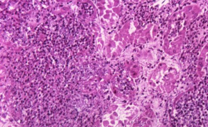 Invasive Candidiasis in 2026: Harmonizing Global and US Guidance in an Era of Diagnostic and Stewardship Complexity