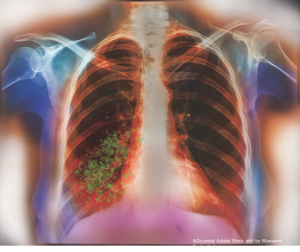 Considerations for Aerosolized Antibiotics in Multidrug-Resistant Gram-Negative Pneumonia