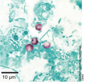 Cryptosporidium: A Potentially Fatal Cause of Diarrhea in a Heart Transplant Recipient