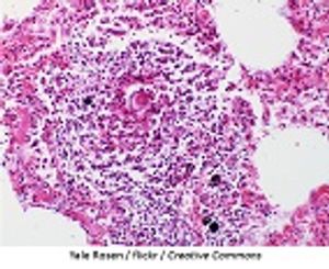 Novel Hybrid Livestock Schistosomes Can Infect Humans