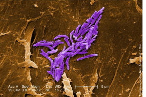 Studies Reveal New Treatment Options for Nontuberculous Mycobacterial Lung Disease
