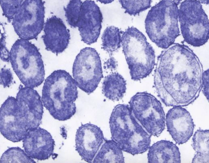 Post-Exposure Protocol for STDs Prompts Resistant Gonorrhea