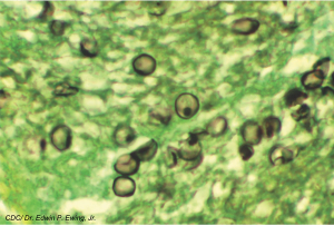 Early Adjunctive Corticosteroids Do Not Improve Outcomes in HIV-Negative Adults With PcP
