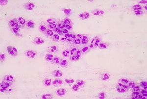 IV Contrast Media Does Not Raise the Risk of AKI in Sepsis Patients