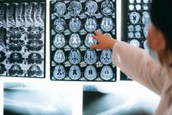 Impact of HIV on Brain Structure and Function