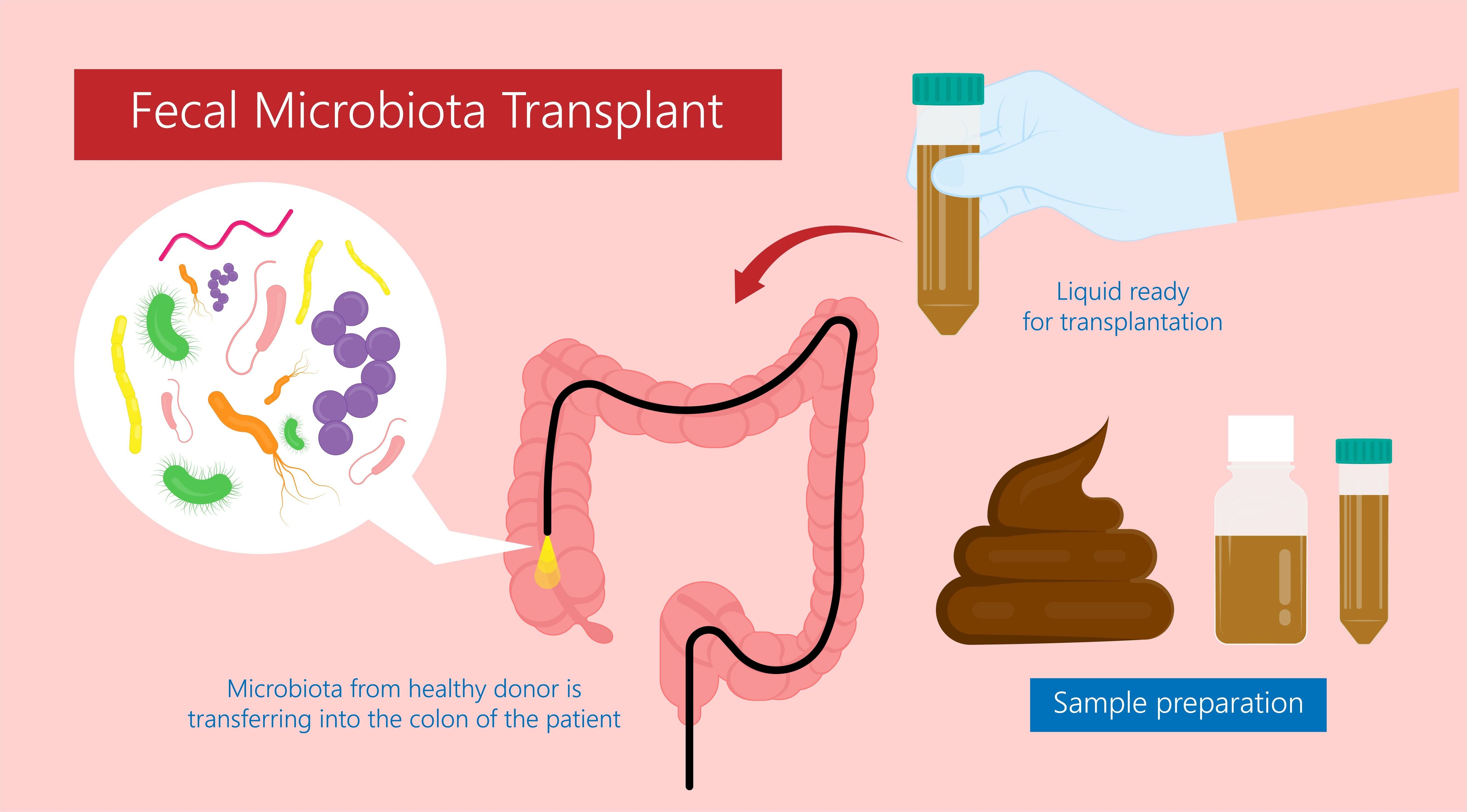 A fecal microbiota transplant (FMT) trial was halted early due to clear evidence the treatment was superior to placebo.