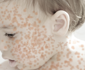 Measles 2025: Looking Back and Moving Forward