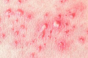 Taking A Closer Look at Shingrix: The New Shingles Vaccine