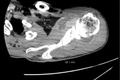 Disseminated Gonococcal Infection Complicated by Suspected Osteomyelitis of Humeral Head