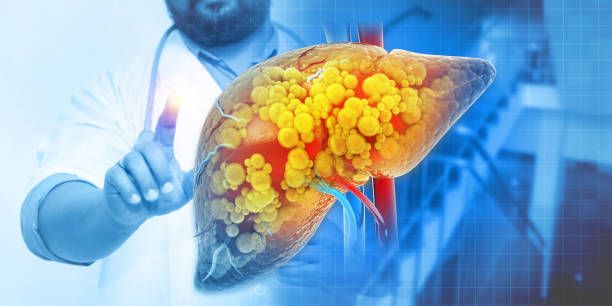 La coinfezione con HIV/epatite B (HBV) aumenta il rischio di sviluppare una malattia epatica allo stadio terminale La coinfezione con HIV/epatite B (HBV) aumenta il rischio di sviluppare una malattia epatica allo stadio terminale