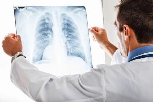 Hiding in Plain Air: Recognizing Endemic Mycoses in Community-Acquired Pneumonia