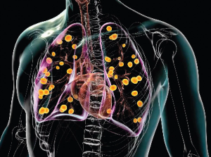 Histoplasmosis: A Common Infection Hiding in Plain Sight