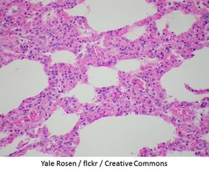 Respiratory Syncytial Virus Testing Uncommon in Pregnant Mothers