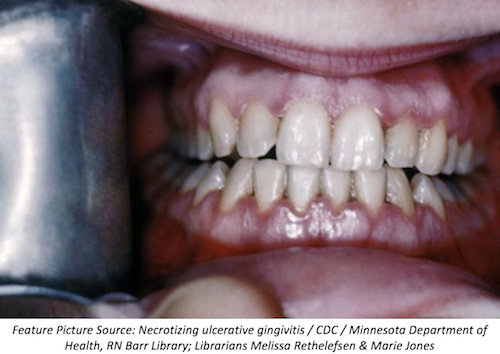 Necrotizing Stomatitis As First Sign Of Hiv Infection Necrotizing Stomatitis As First Sign Of Hiv Infection