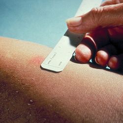 Tuberculosis Testing in New HIV Patients Does Not Effect ART Regimen
