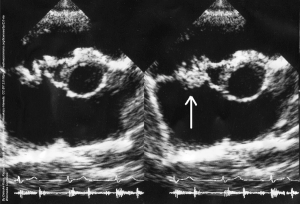 Partial Oral Treatment of Infective Endocarditis Can Be Effective in Select Patients: Review of the POET Trial