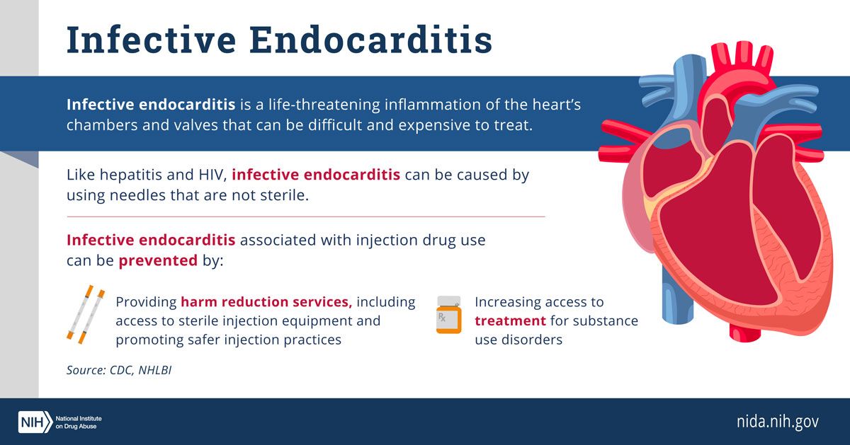 Seeking Solutions for Endocarditis in People Who Inject Drugs