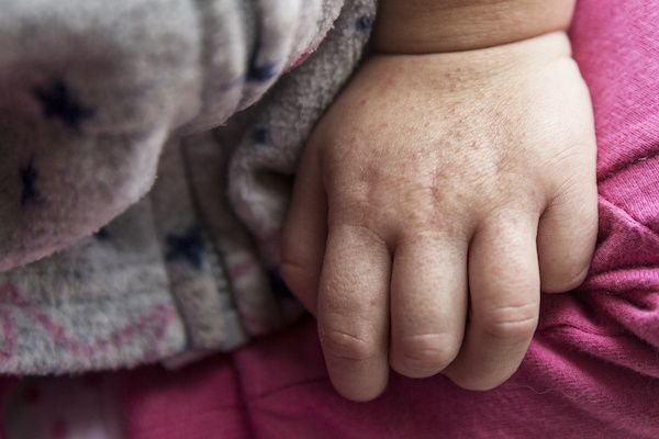 Scarlet fever outbreak in Scotland: what you need to know