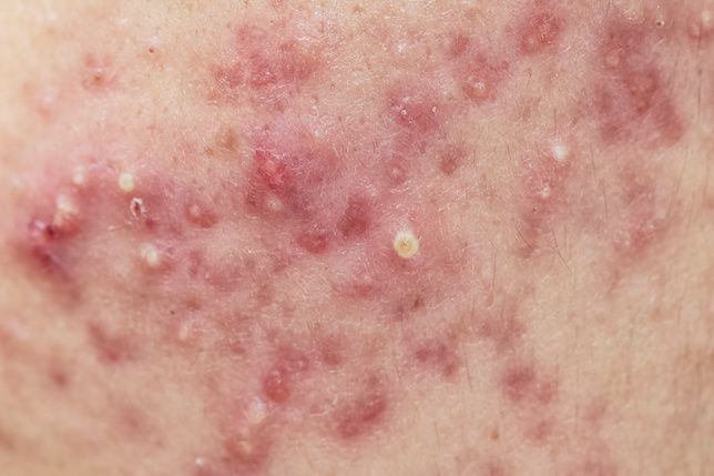 Truncal Rash Area Study: Facial, Truncal Acne Associated with Greater Impact on Health ...
