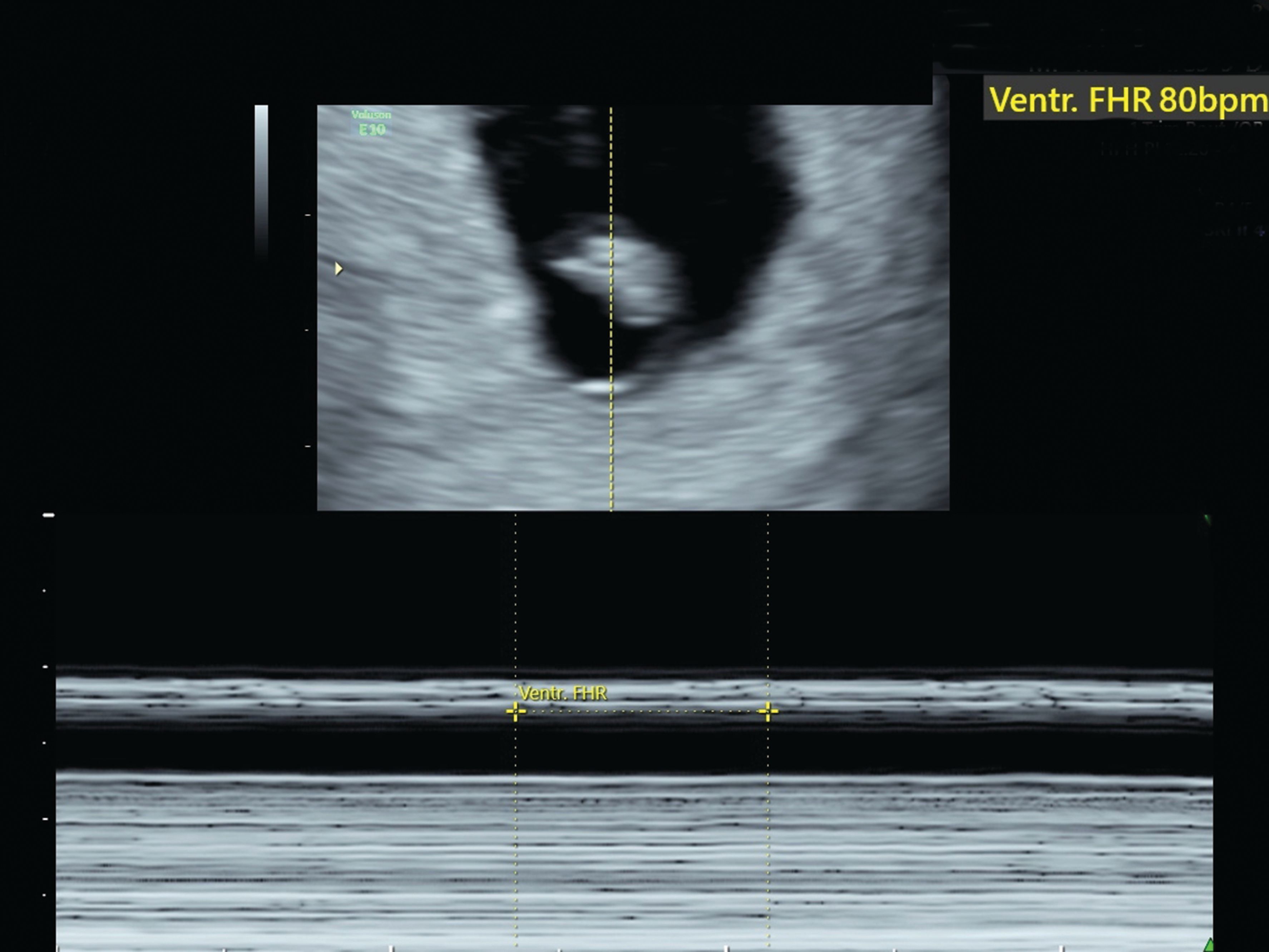 An imaging approach to early pregnancy failure