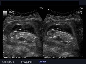 What is your Diagnosis: Fetus at 12 Weeks Gestation