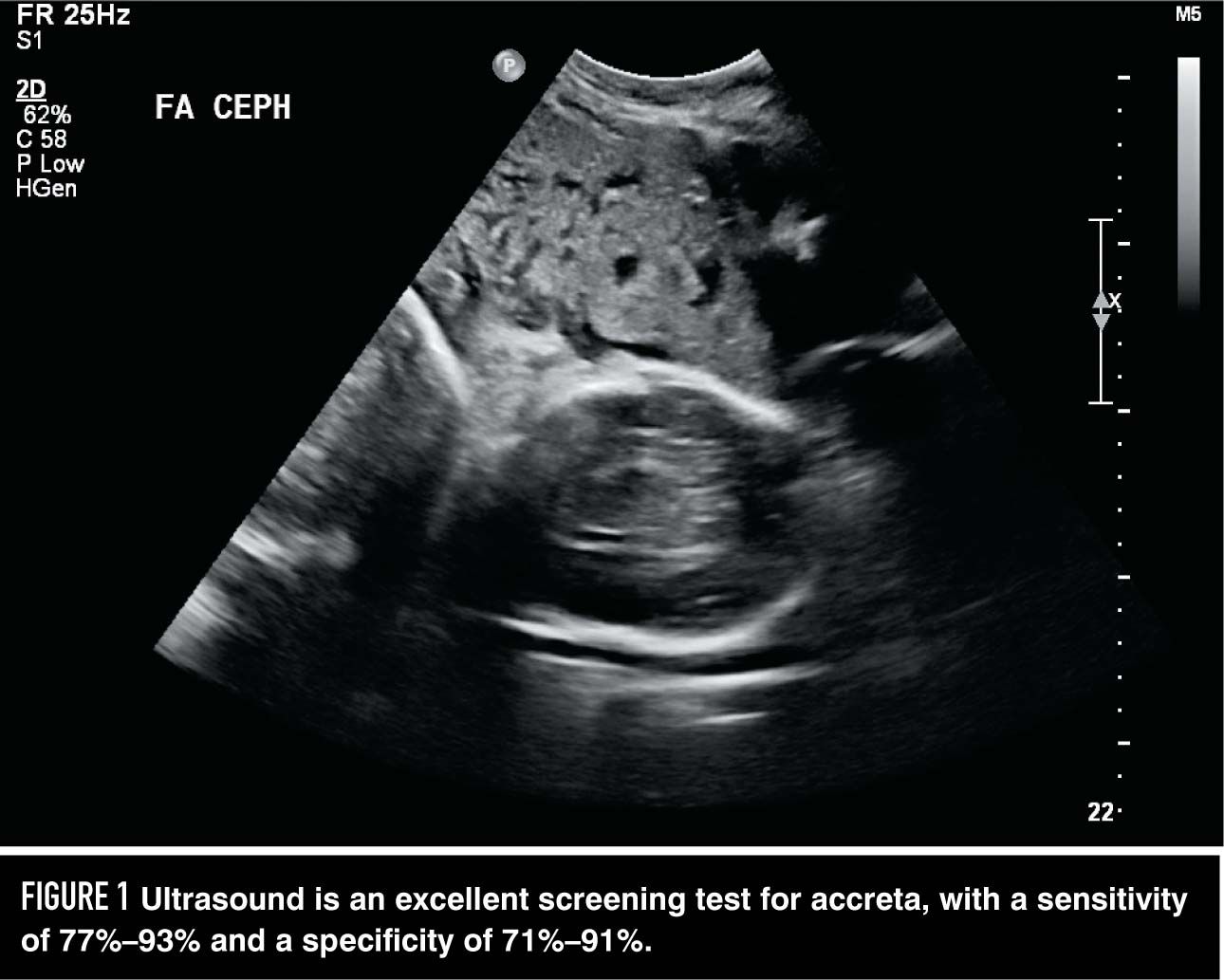 placenta percreta ultrasound