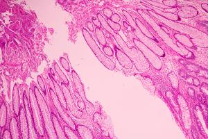 Steven J. Chmura, MD, PhD, compares addition of metastases-directed therapy vs SOC alone for oligometastatic breast cancer