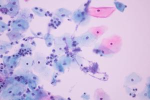 Novel antifungal treatment approved for vaginal candidiasis