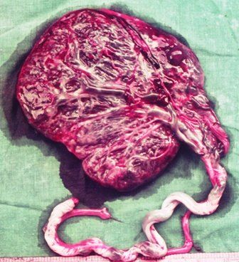 Placental Conditions | Contemporary OB/GYN