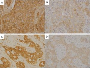 Insulin resistance contributes to racial disparities in breast cancer prognosis in US women