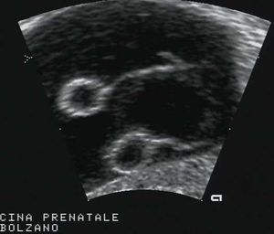 LONG Section of Yolk Stalks and Sacs Normal Yolk Sacs in Monoamn. Twins