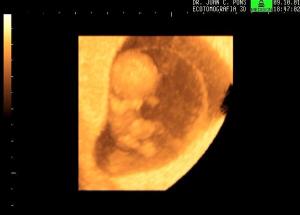 3D Surface Reconstruction Omphalocele at 10.5 weeks GA (>9mm diameter)