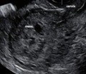Postabortal Placental Polyp or Uterine AVM? Saline Instillation Sonohysterography as a Diagnostic Aid