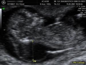 Higroma Quistico (Nuchal Translucency)