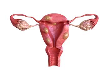 uterine fibroid